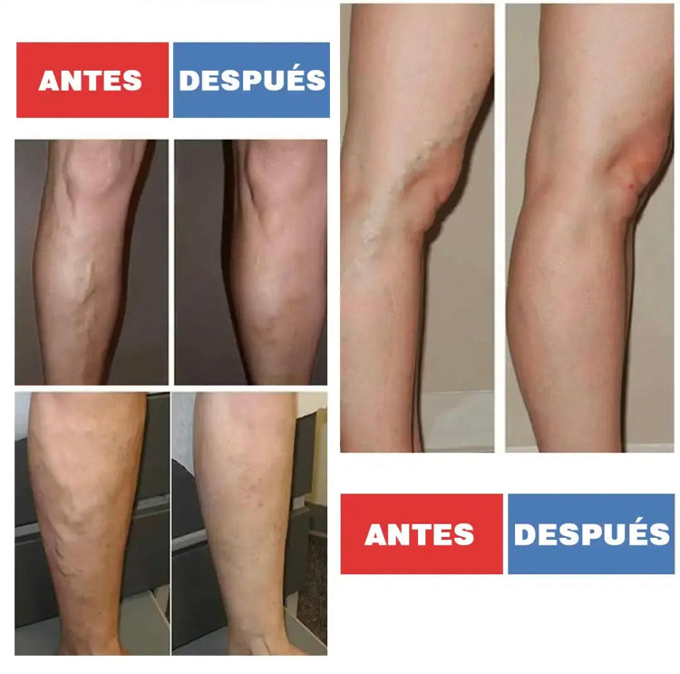 Parche para Varices